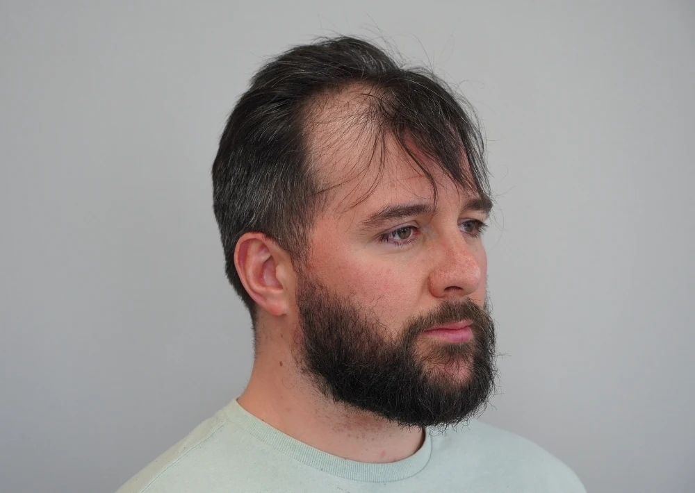 Hair restoration patient before treatment