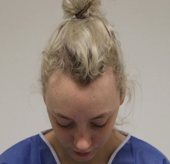 Hair restoration patient before treatment