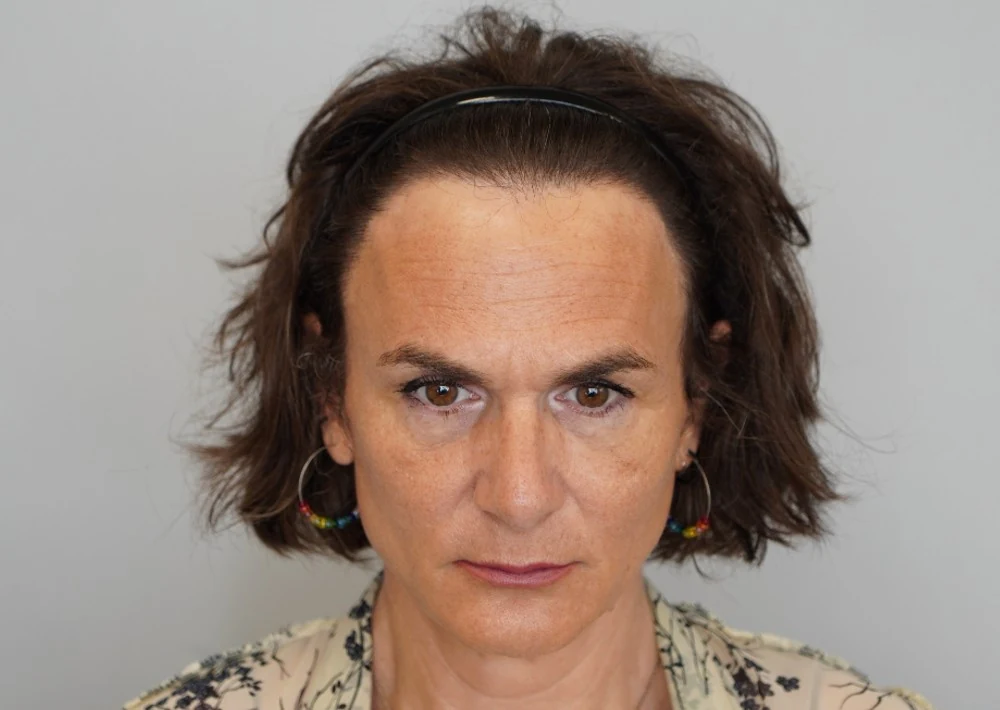 Hair restoration patient after treatment