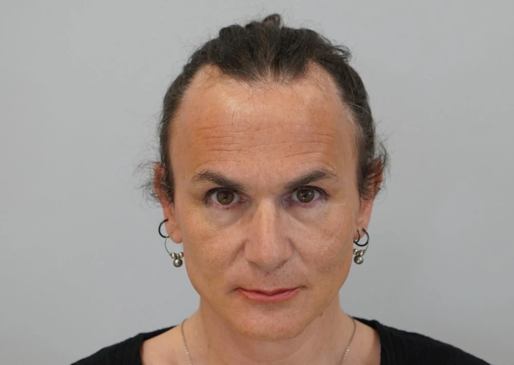 Hair restoration patient before treatment