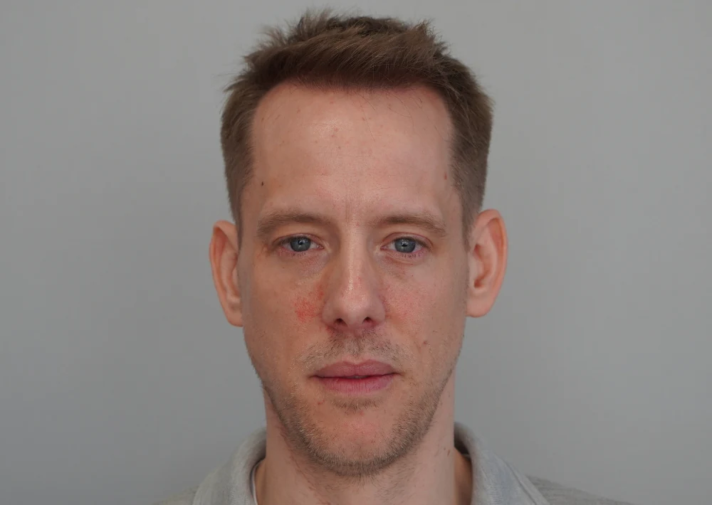 Hair restoration patient after treatment