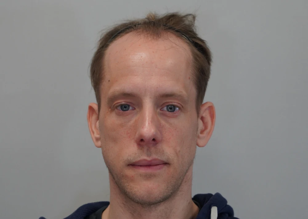 Hair restoration patient before treatment