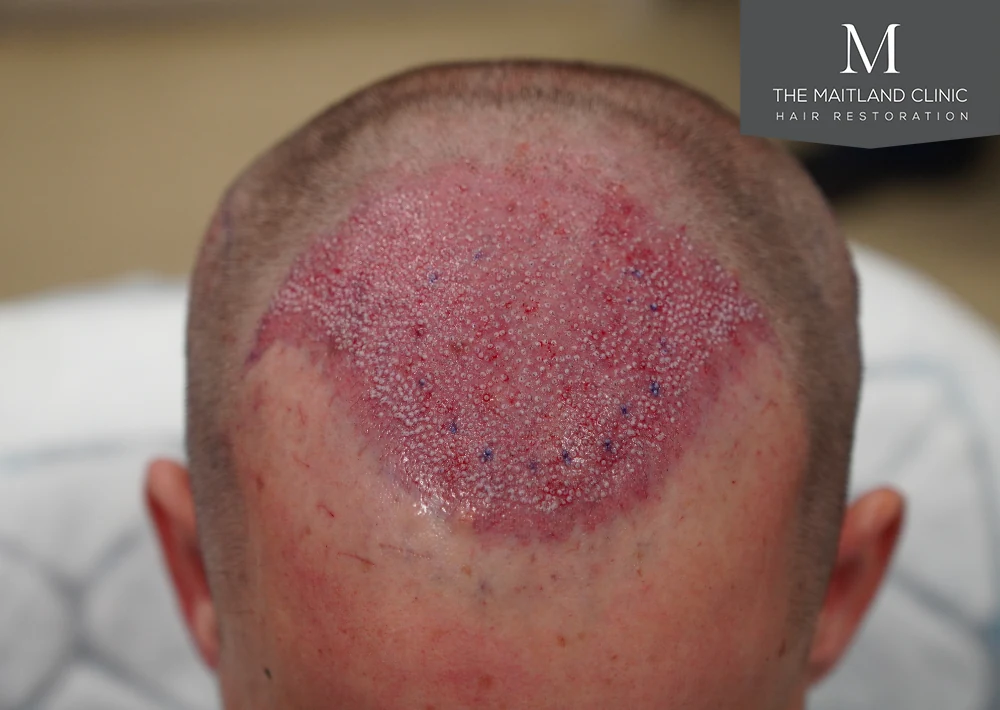 Post-surgery · Frontal view · recipient area