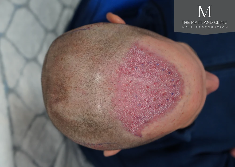 Post-surgery · Overhead view · recipient area