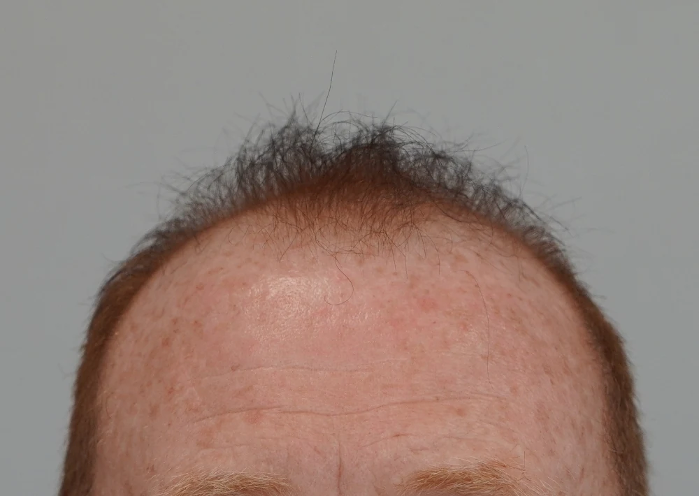 1983 grafts by FUE before treatment