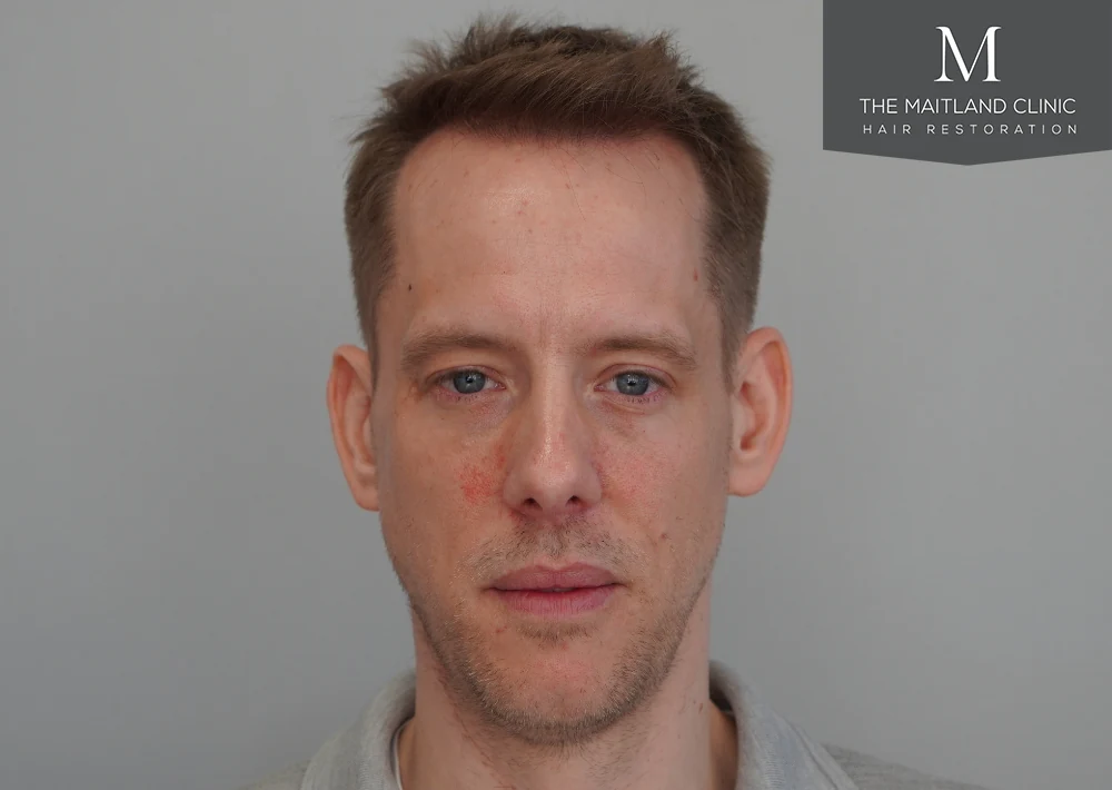After · Front view · hairline