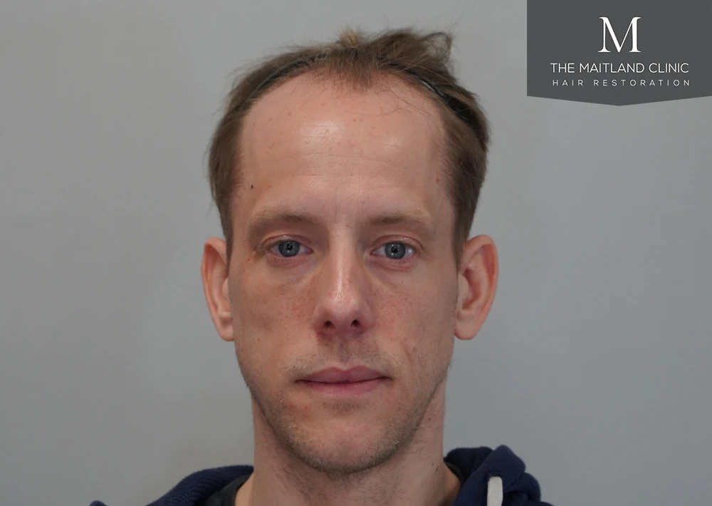 Before · Front view · hairline