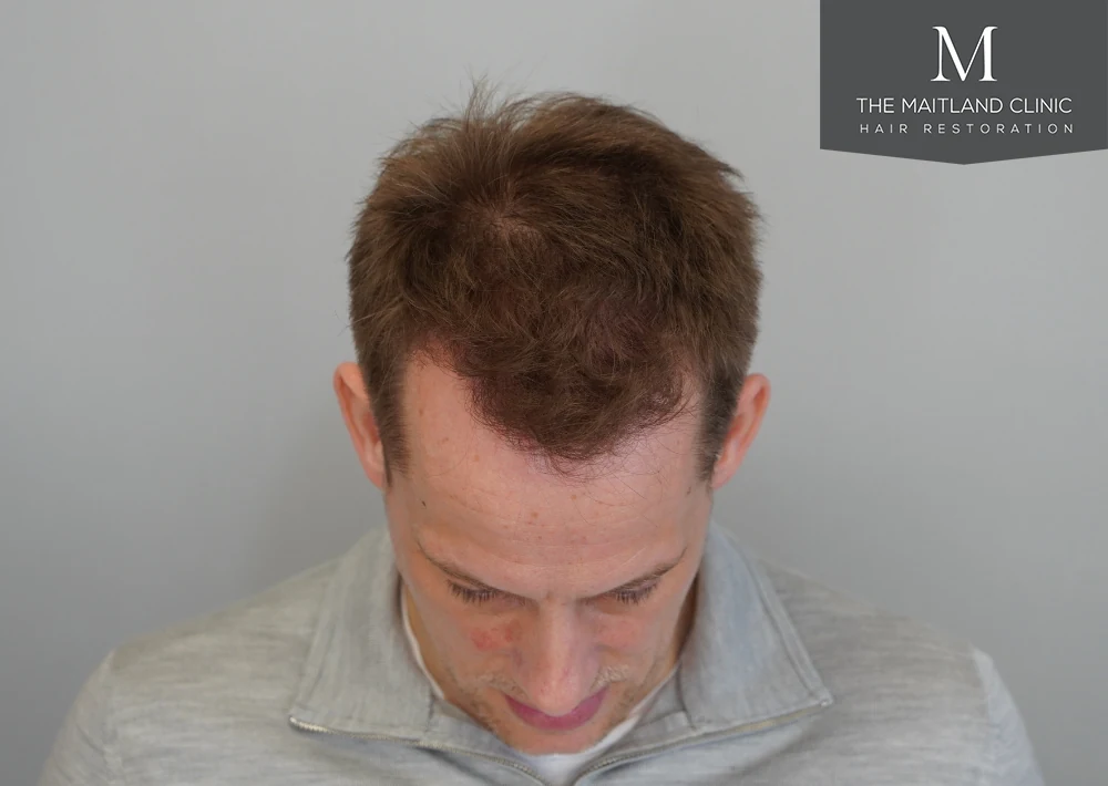 After · Overhead view · frontal coverage