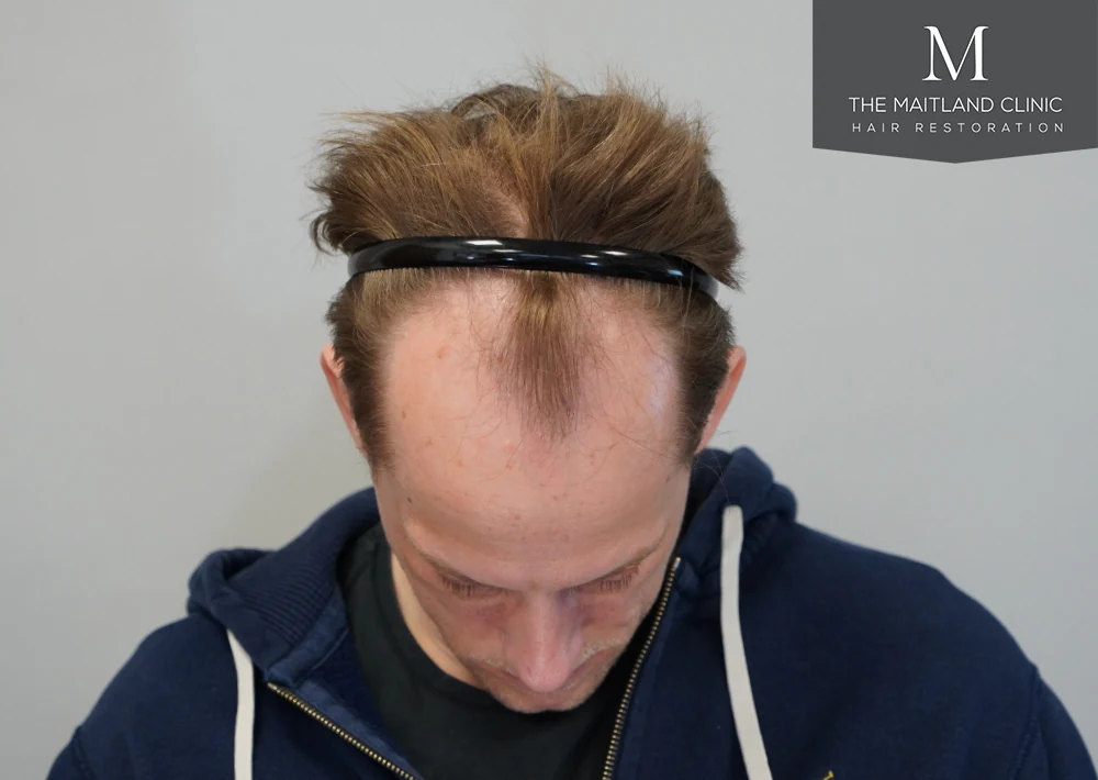 Before · Overhead view · frontal coverage