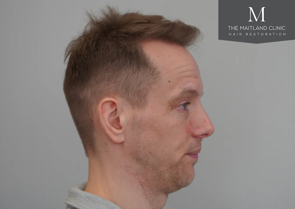 After · Left profile · hairline