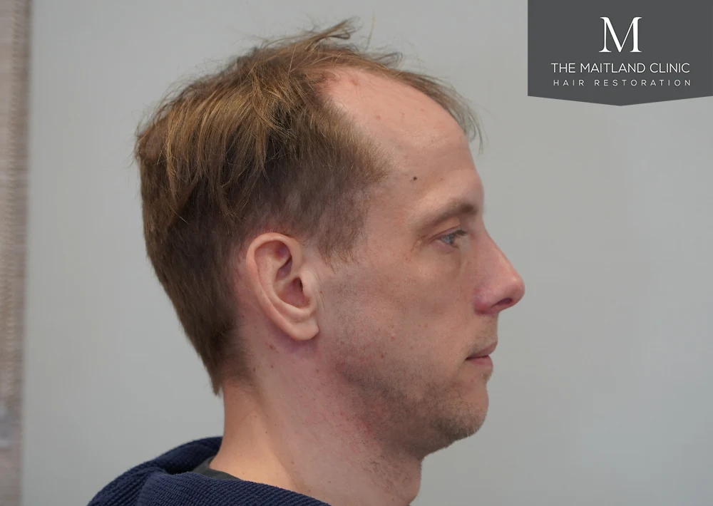 Before · Left profile · hairline