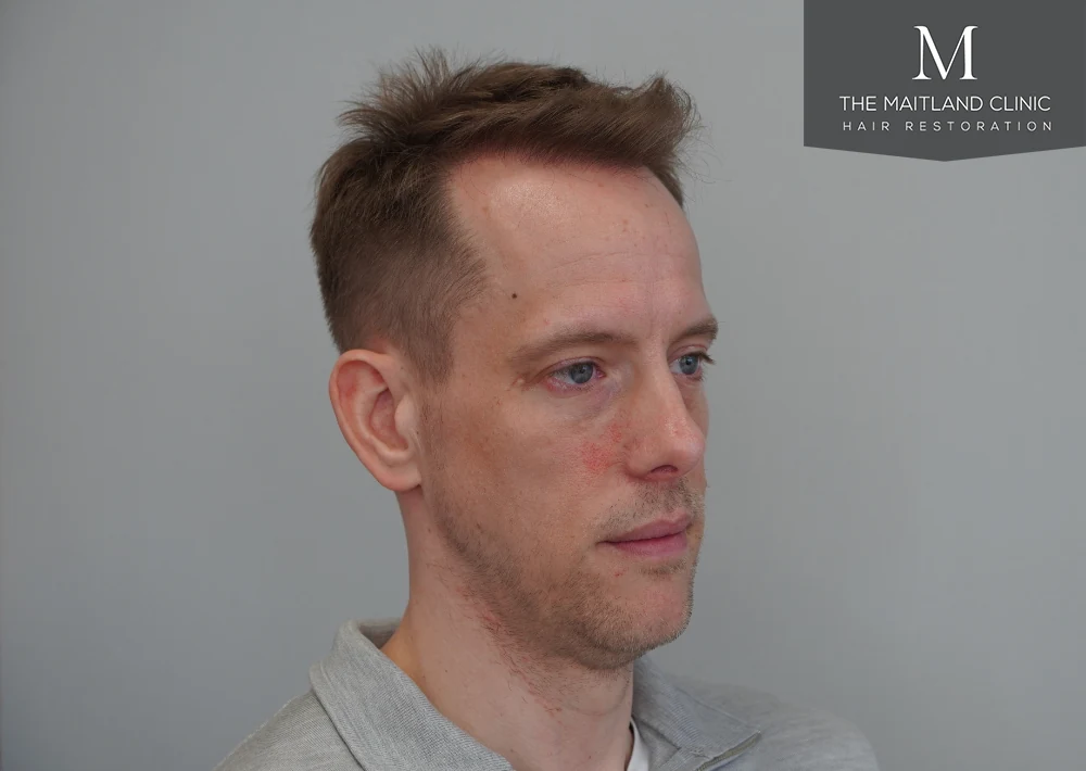 After · Left oblique view · frontal hairline
