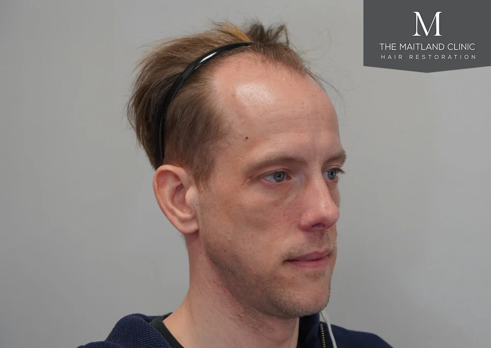 Before · Left oblique view · frontal hairline