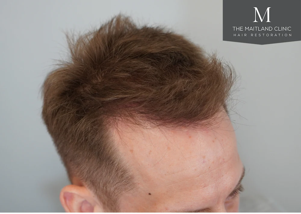 After · Left frontal close-up · hairline