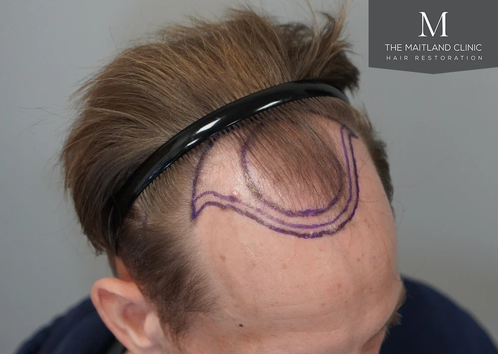Before · Left frontal close-up · hairline