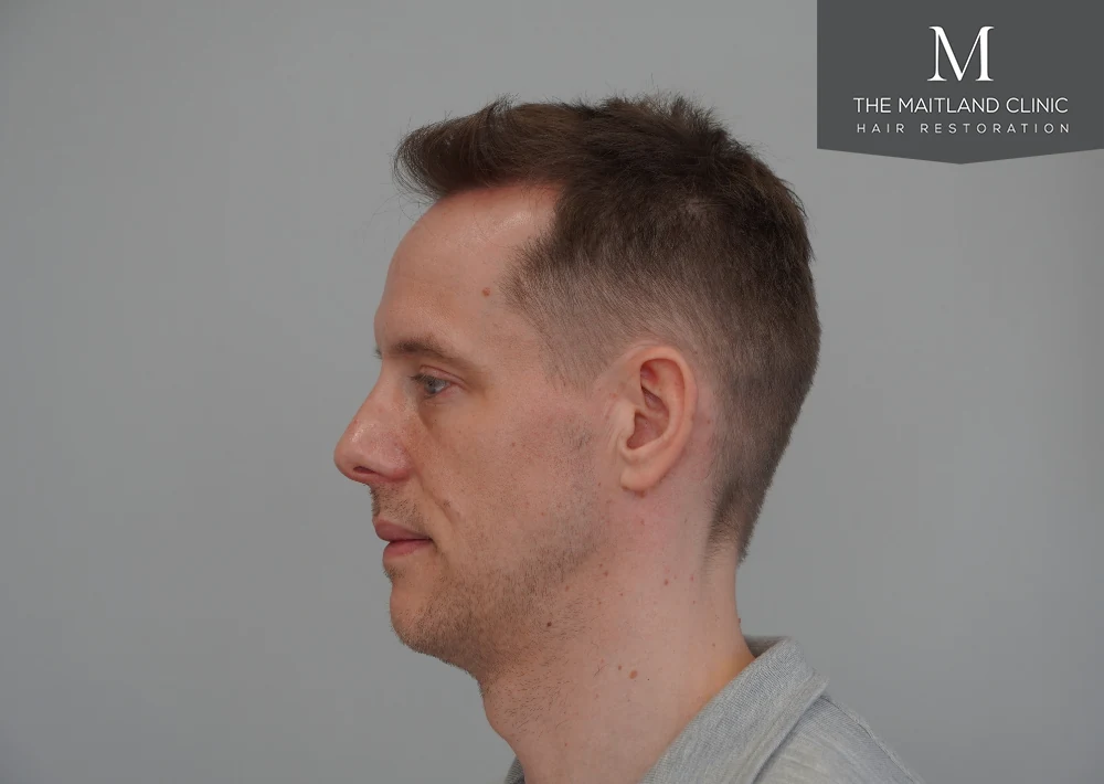 After · Right profile · hairline