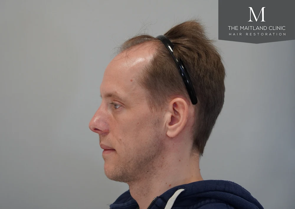 Before · Right profile · hairline