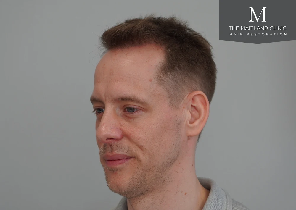 After · Right oblique view · frontal hairline