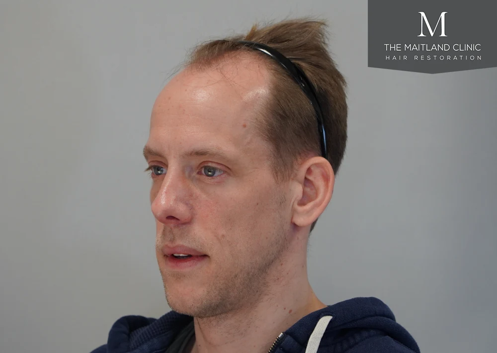 Before · Right oblique view · frontal hairline