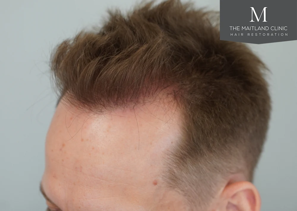 After · Right frontal close-up · hairline