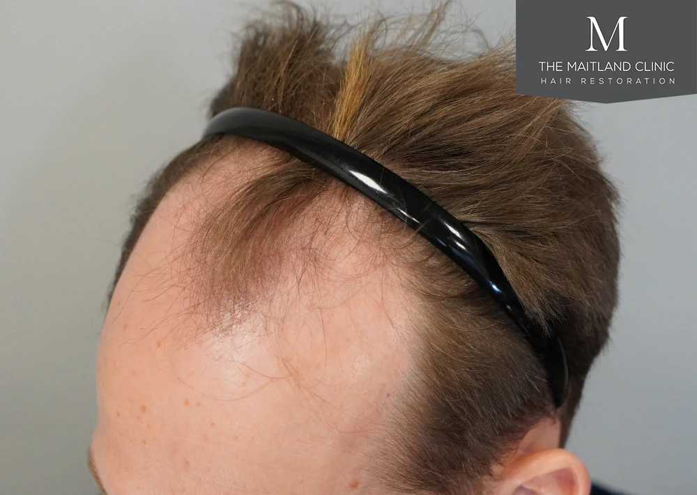 Before · Right frontal close-up · hairline