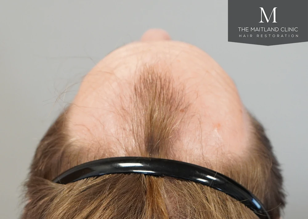 Before · Hairline close-up · head tilted back