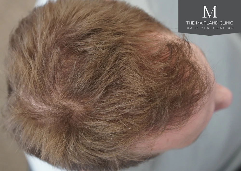 After · Overhead view · scalp coverage