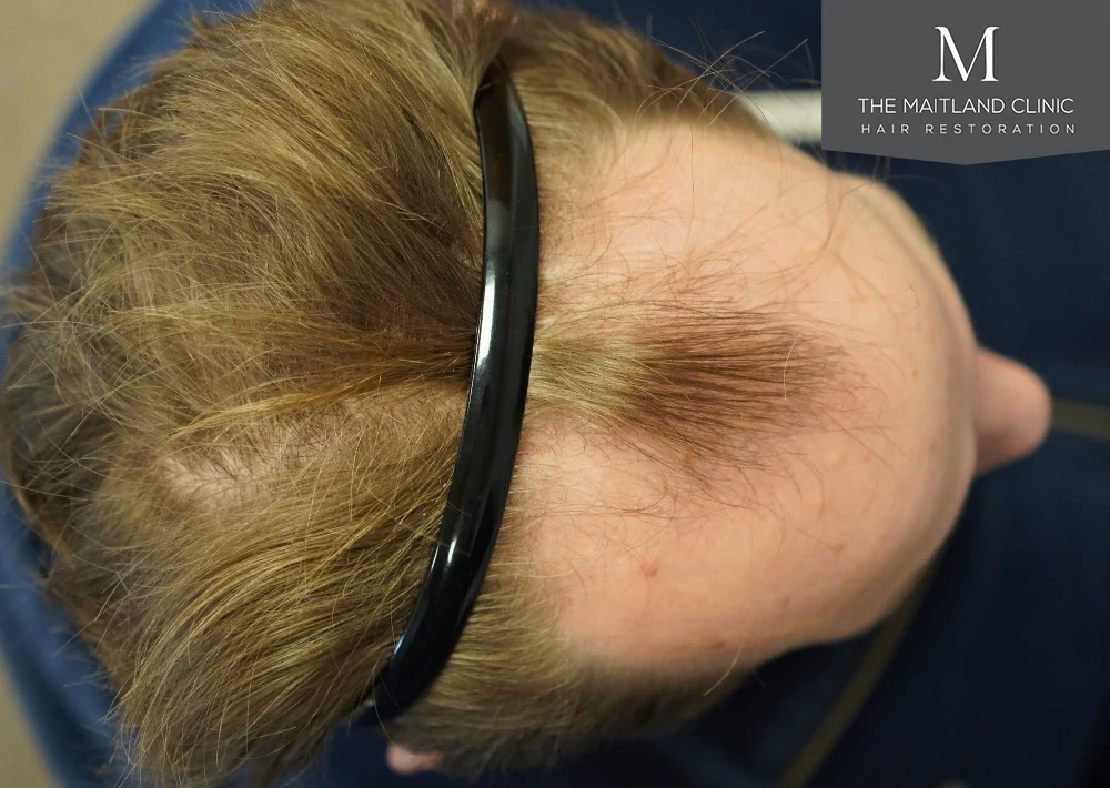 Before · Overhead view · scalp coverage
