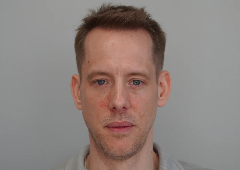 After hair restoration: Male patient underwent FUE procedure of 2023 grafts.