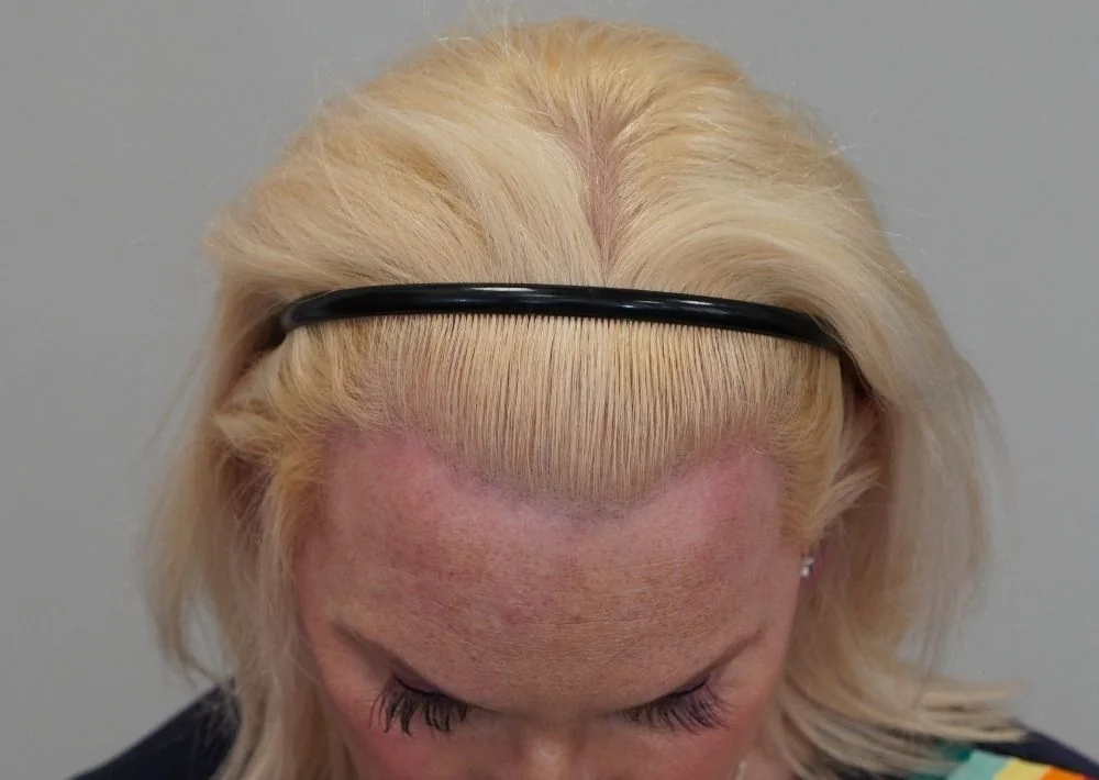 After hair restoration: Transgender patient underwent FUT procedure of 2628 grafts.