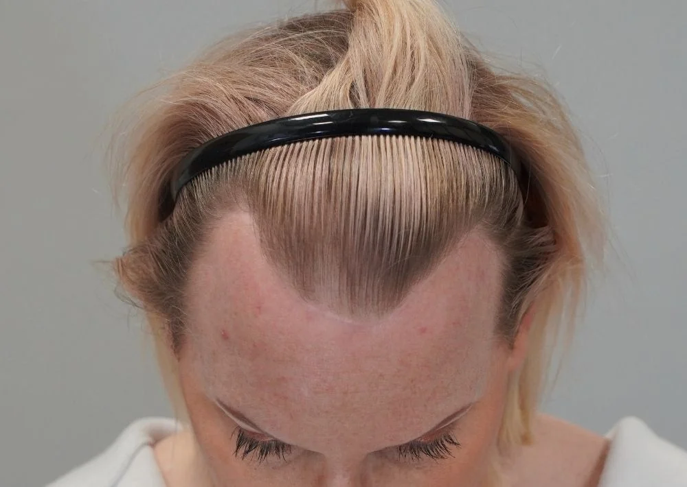 Before hair restoration: Transgender patient underwent FUT procedure of 2628 grafts.