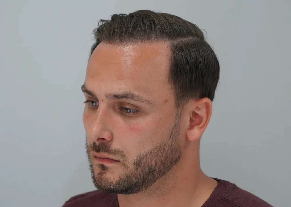 After hair restoration: Male patient underwent a repair procedure of 464 grafts.
