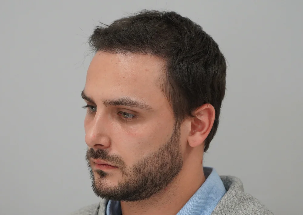 Before hair restoration: Male patient underwent a repair procedure of 464 grafts.