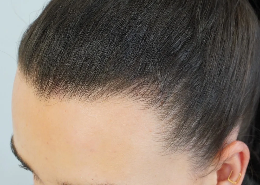 After hair restoration: Female patient underwent FUT procedure of 904 grafts.