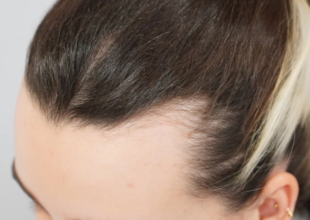 Before hair restoration: Female patient underwent FUT procedure of 904 grafts.