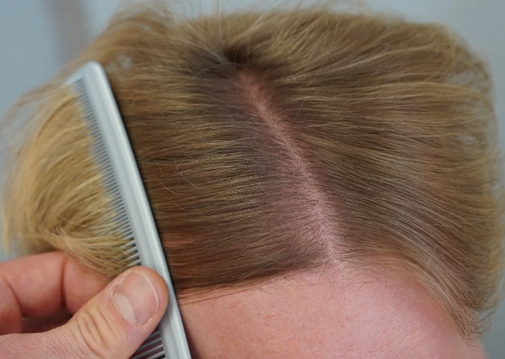 After hair restoration: Male patient underwent FUE procedure of 1800 grafts.