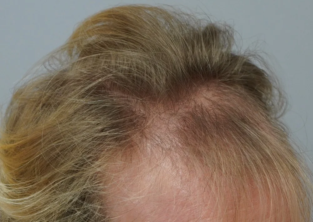 Before hair restoration: Male patient underwent FUE procedure of 1800 grafts.