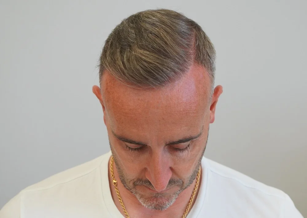 After hair restoration: Male patient underwent FUE procedure of 3487 grafts.