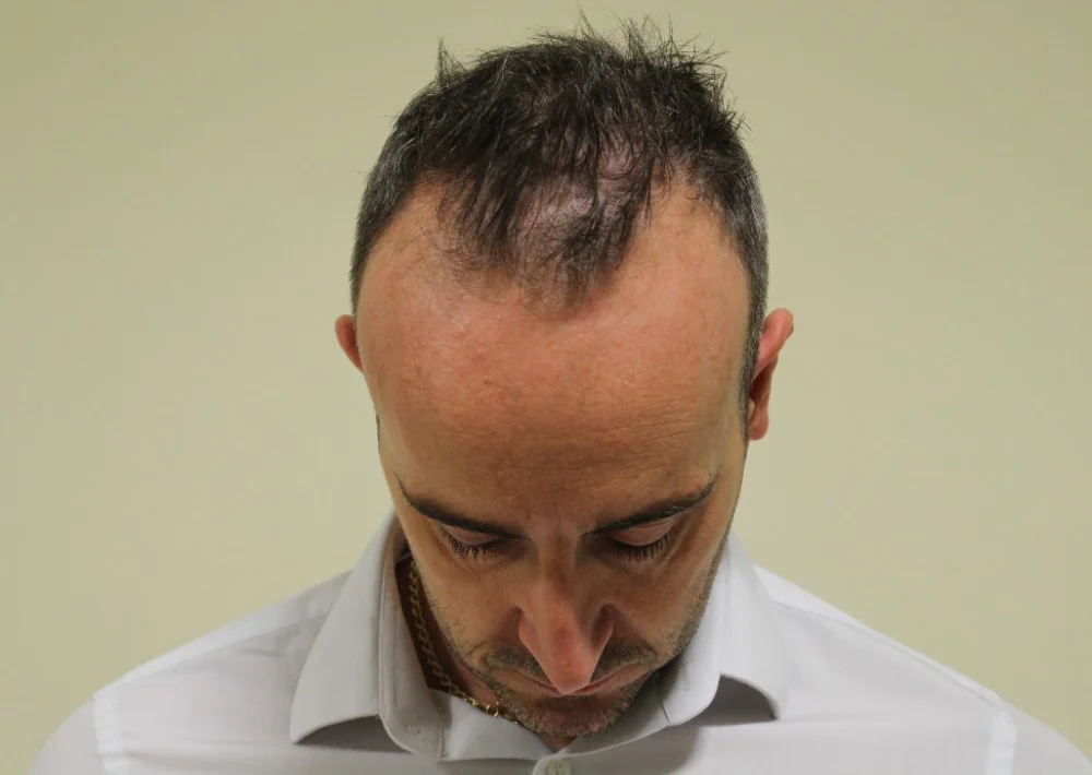 Before hair restoration: Male patient underwent FUE procedure of 3487 grafts.