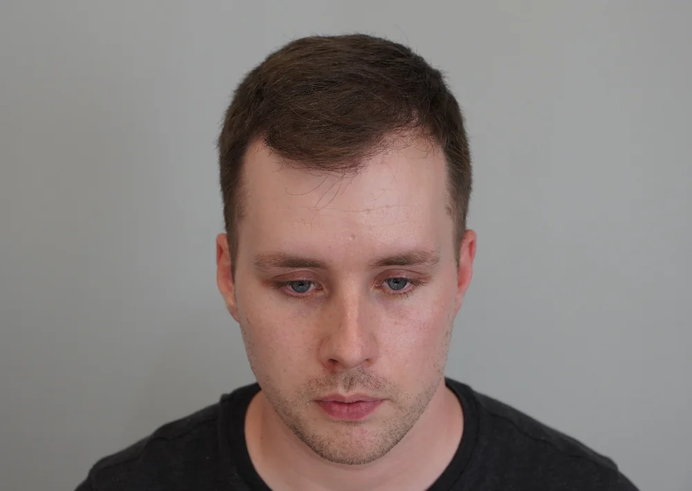 After hair restoration: Male patient underwent FUE procedure of 2027 grafts.