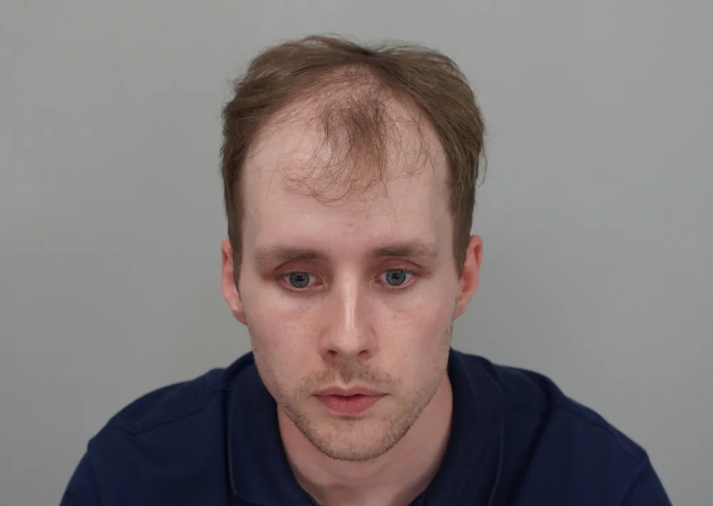 Before hair restoration: Male patient underwent FUE procedure of 2027 grafts.