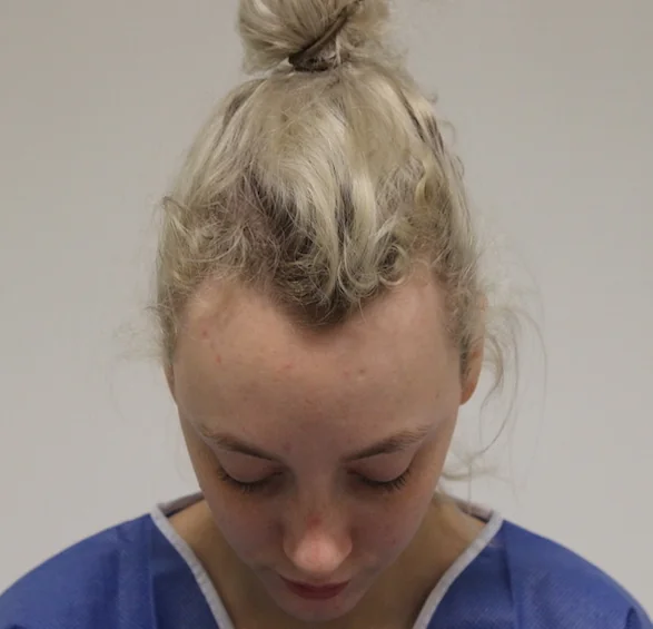 Before hair restoration: Female patient underwent FUT procedure of 1515 grafts.