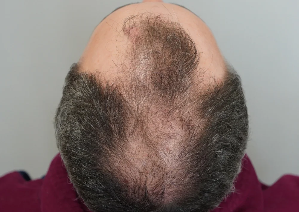 After hair restoration: Male patient took hair loss medication.