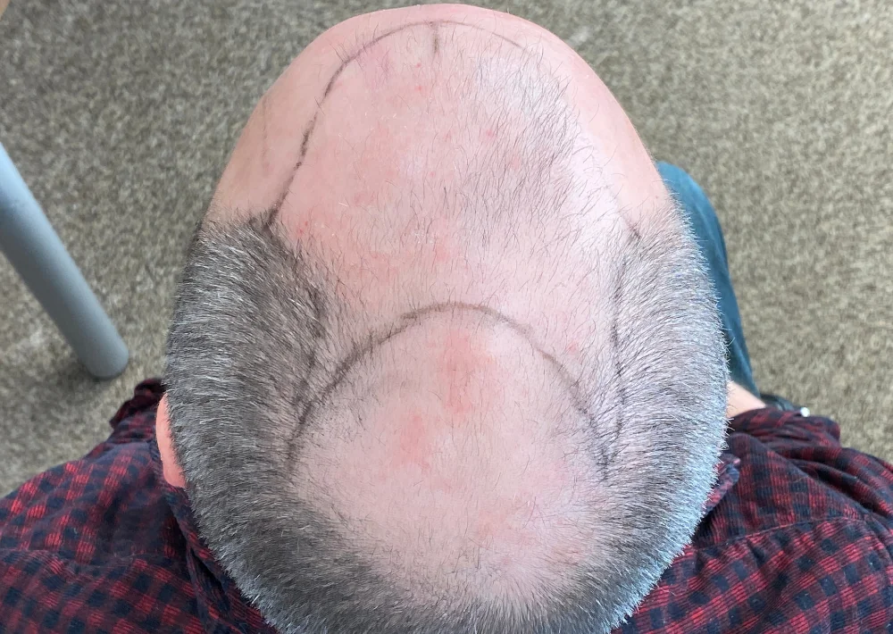 Before hair restoration: Male patient took hair loss medication.
