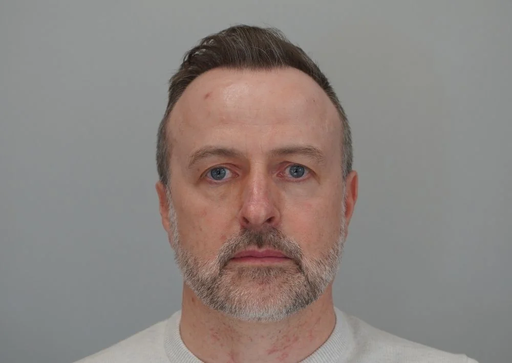 After hair restoration: Male patient underwent FUE procedure of 2269 grafts.