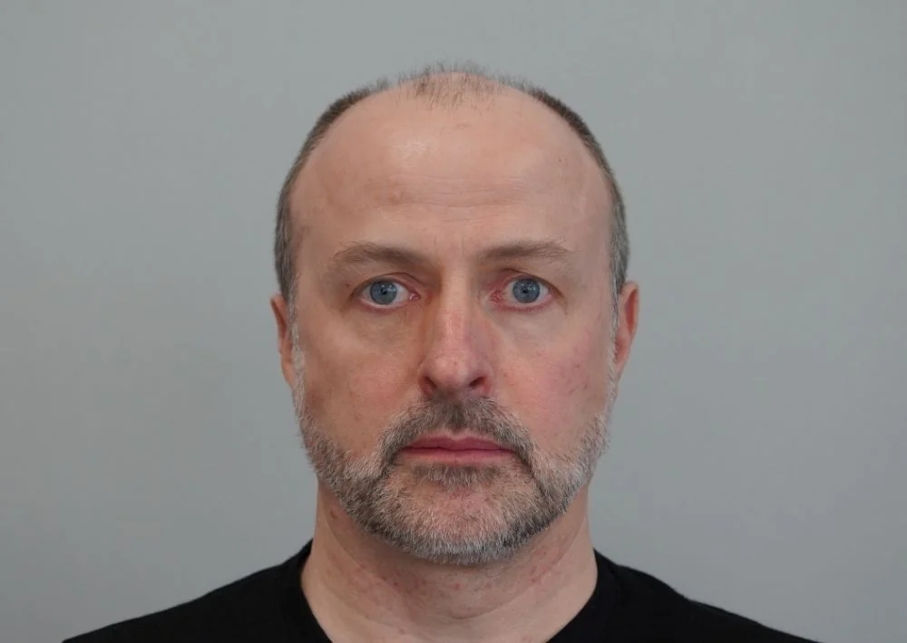 Before hair restoration: Male patient underwent FUE procedure of 2269 grafts.
