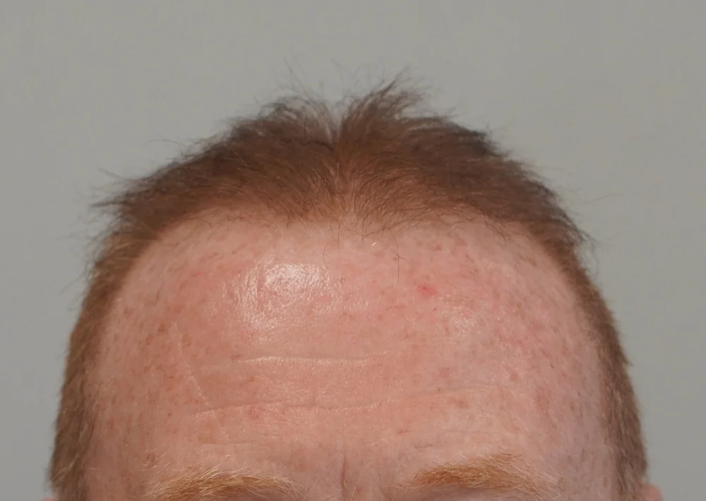 After hair restoration: Male patient underwent FUE procedure of 1983 grafts.