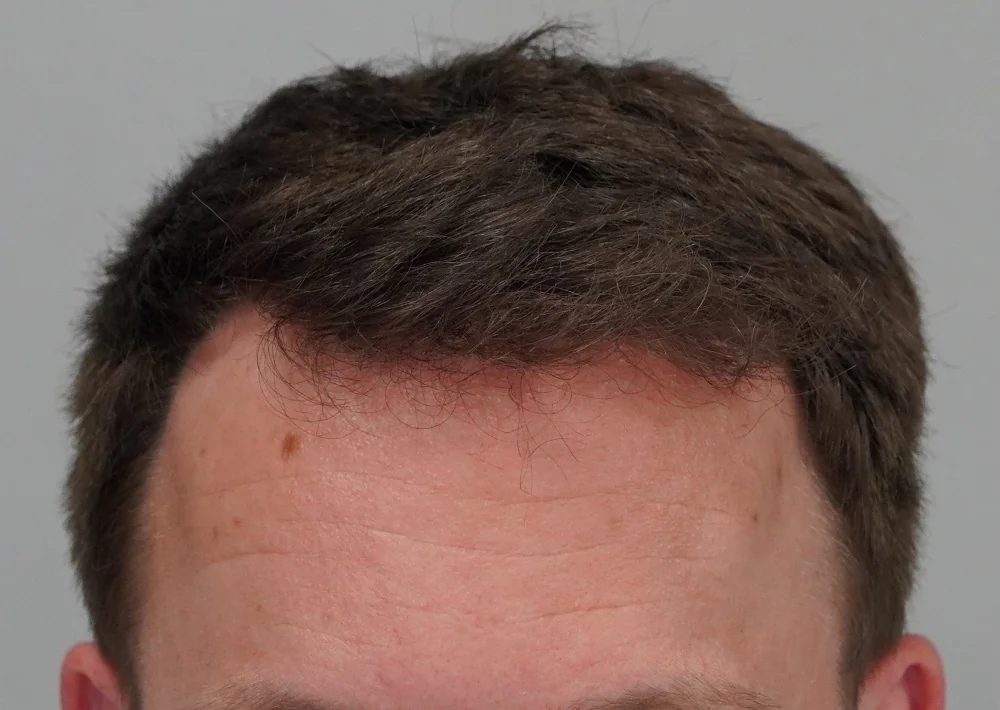After hair restoration: Male patient underwent FUE procedure of 1516 grafts.