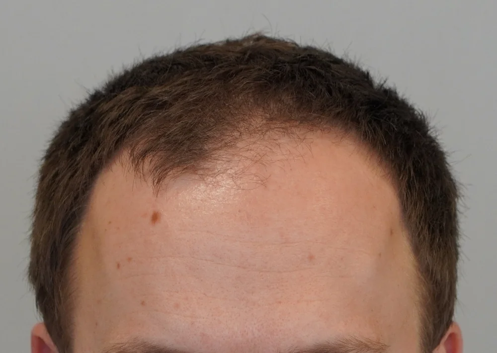 Before hair restoration: Male patient underwent FUE procedure of 1516 grafts.