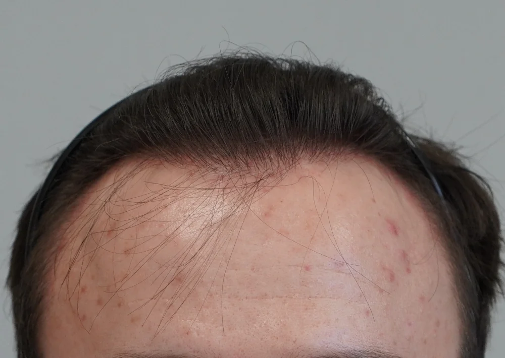 After hair restoration: Male patient underwent FUE procedure of 1551 grafts.